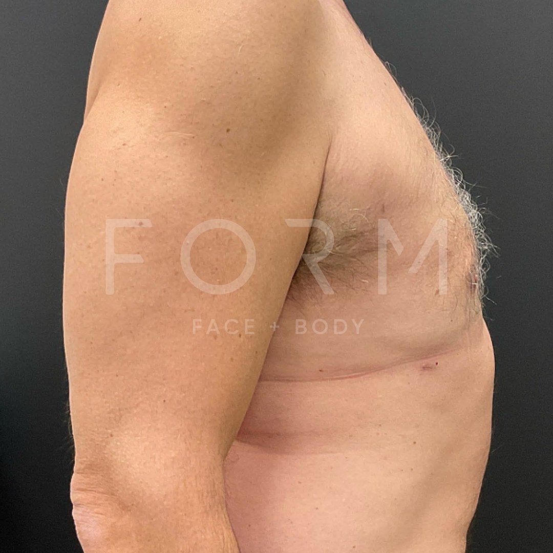 Gynecomastia Before & After