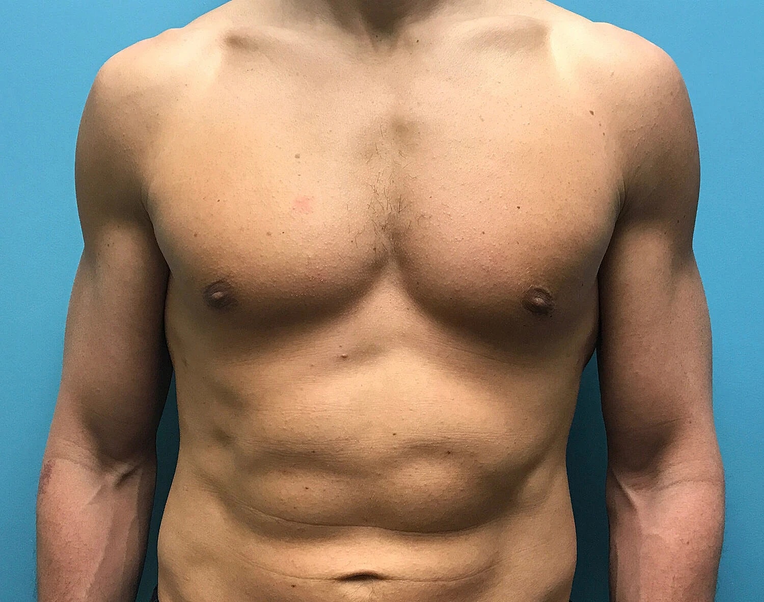 Gynecomastia Before & After