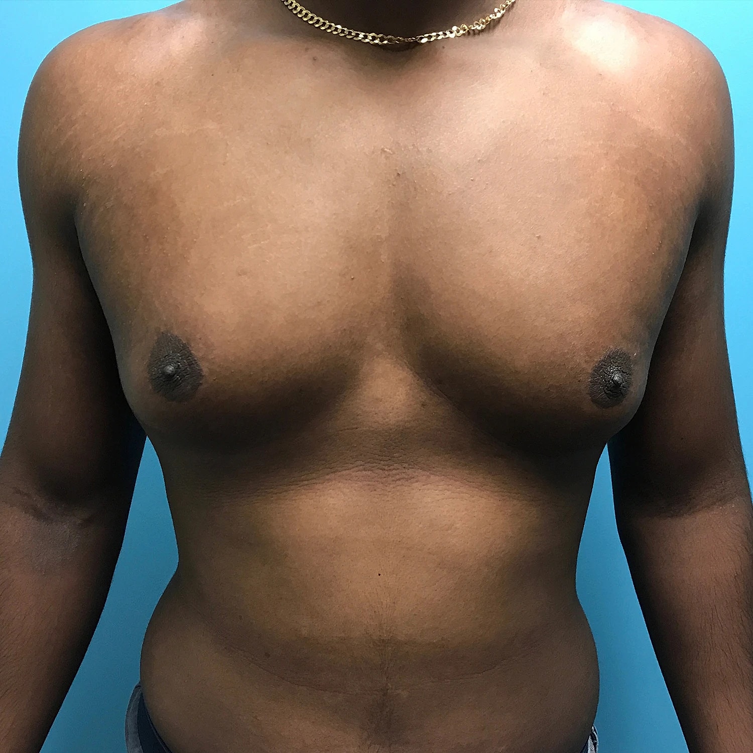 Gynecomastia Before & After