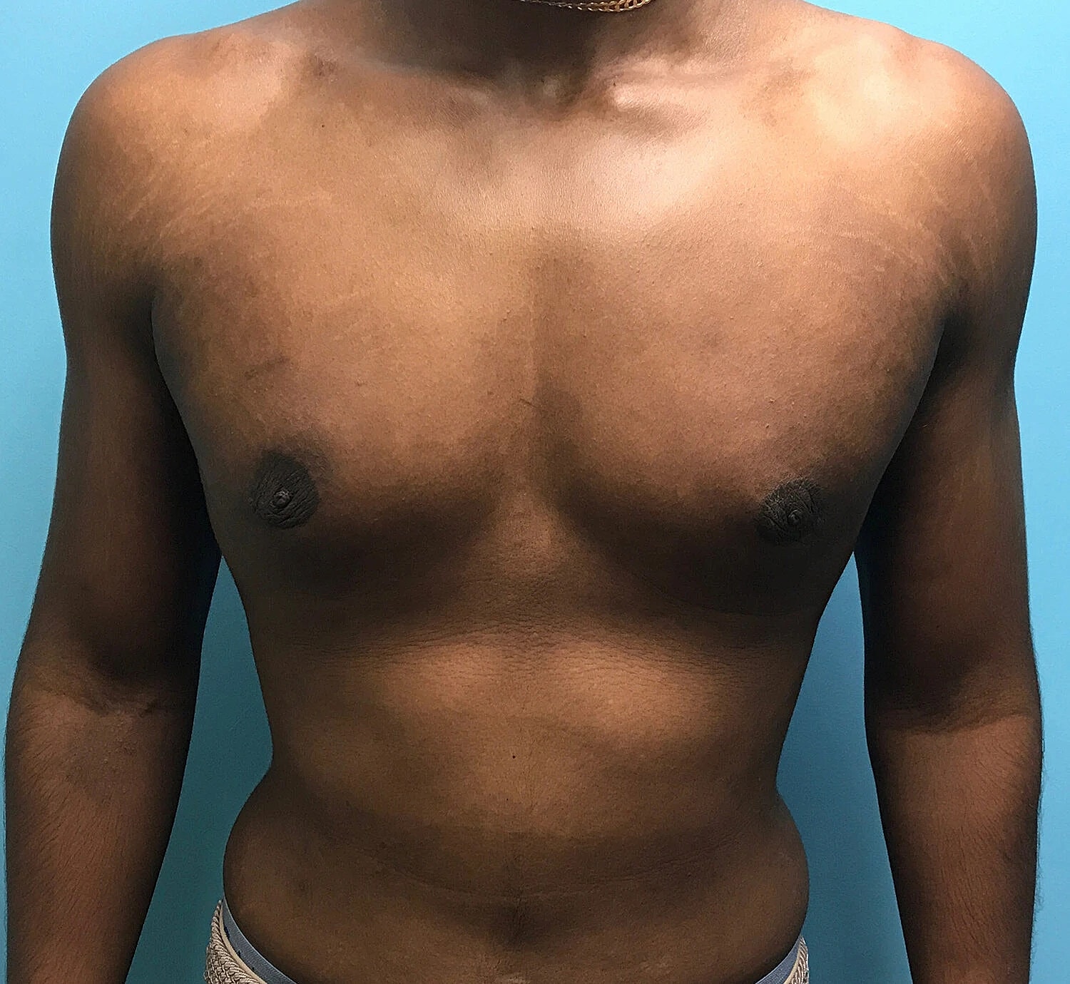 Gynecomastia Before & After