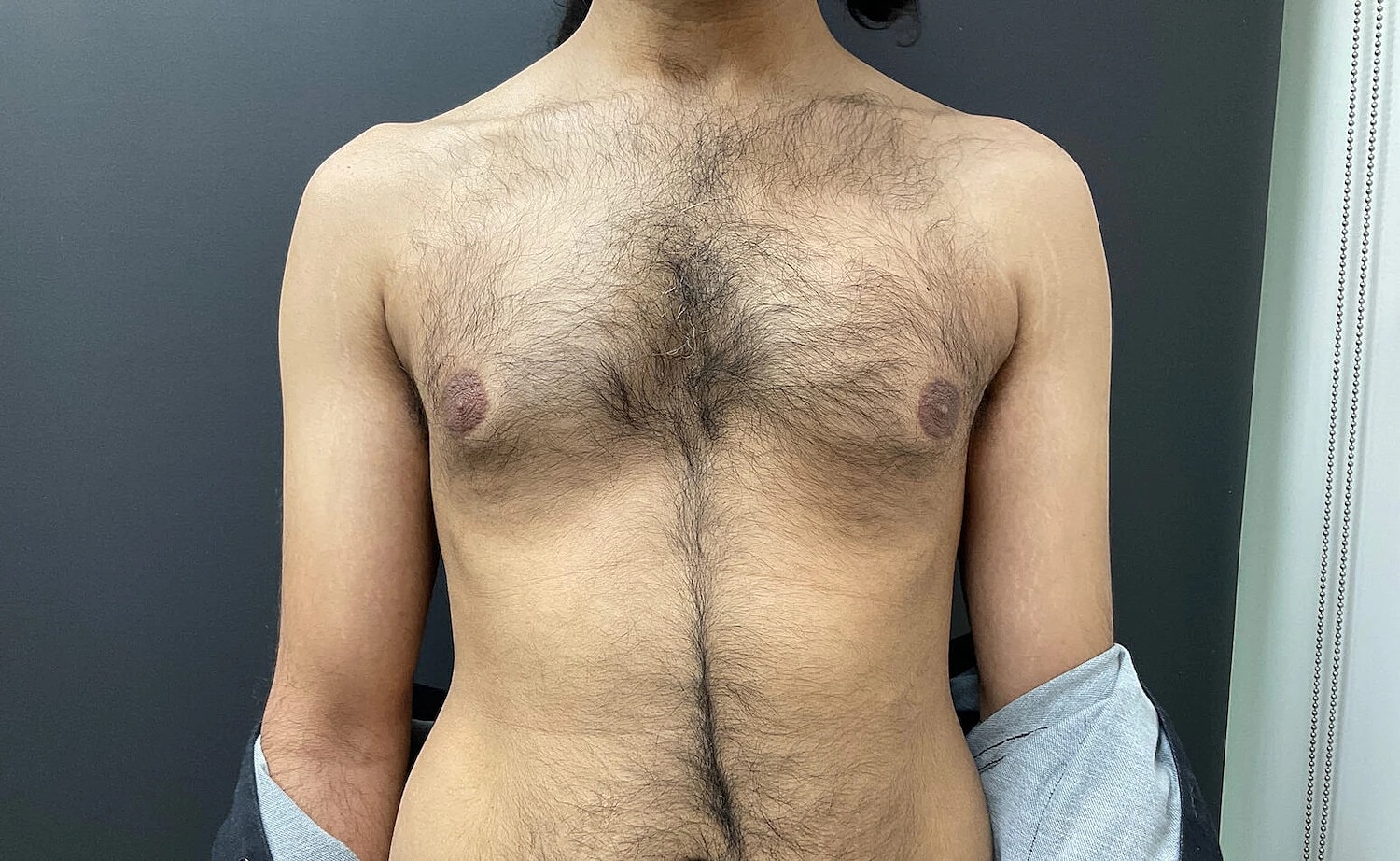 Gynecomastia Before & After