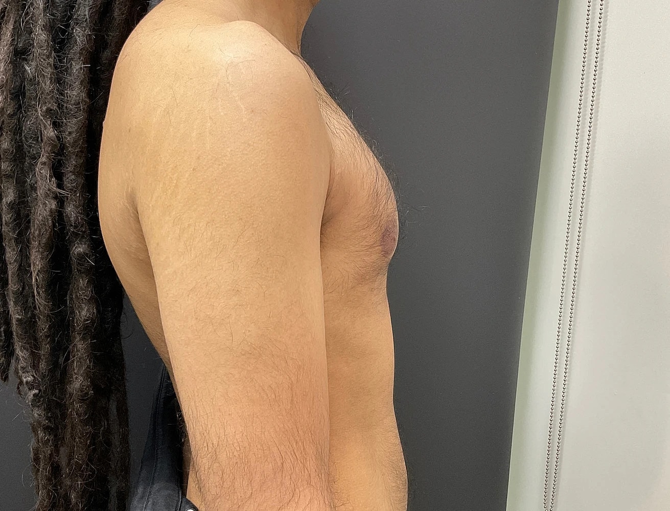 Gynecomastia Before & After