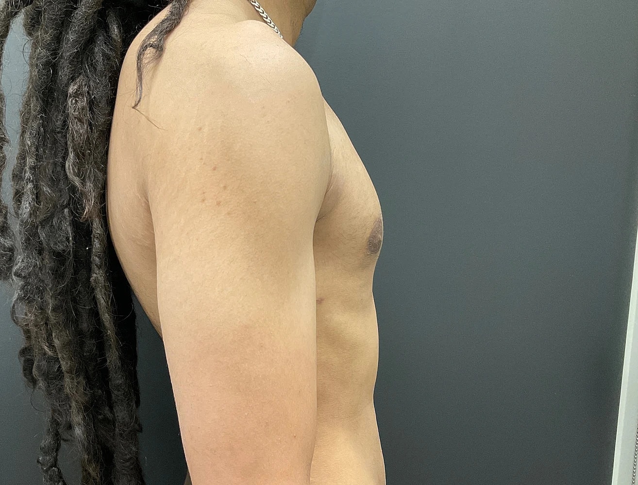Gynecomastia Before & After