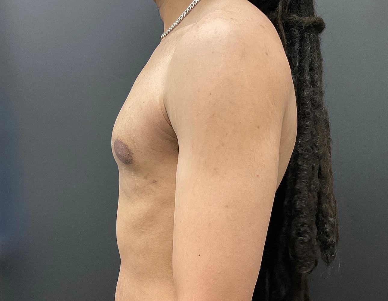 Gynecomastia Before & After