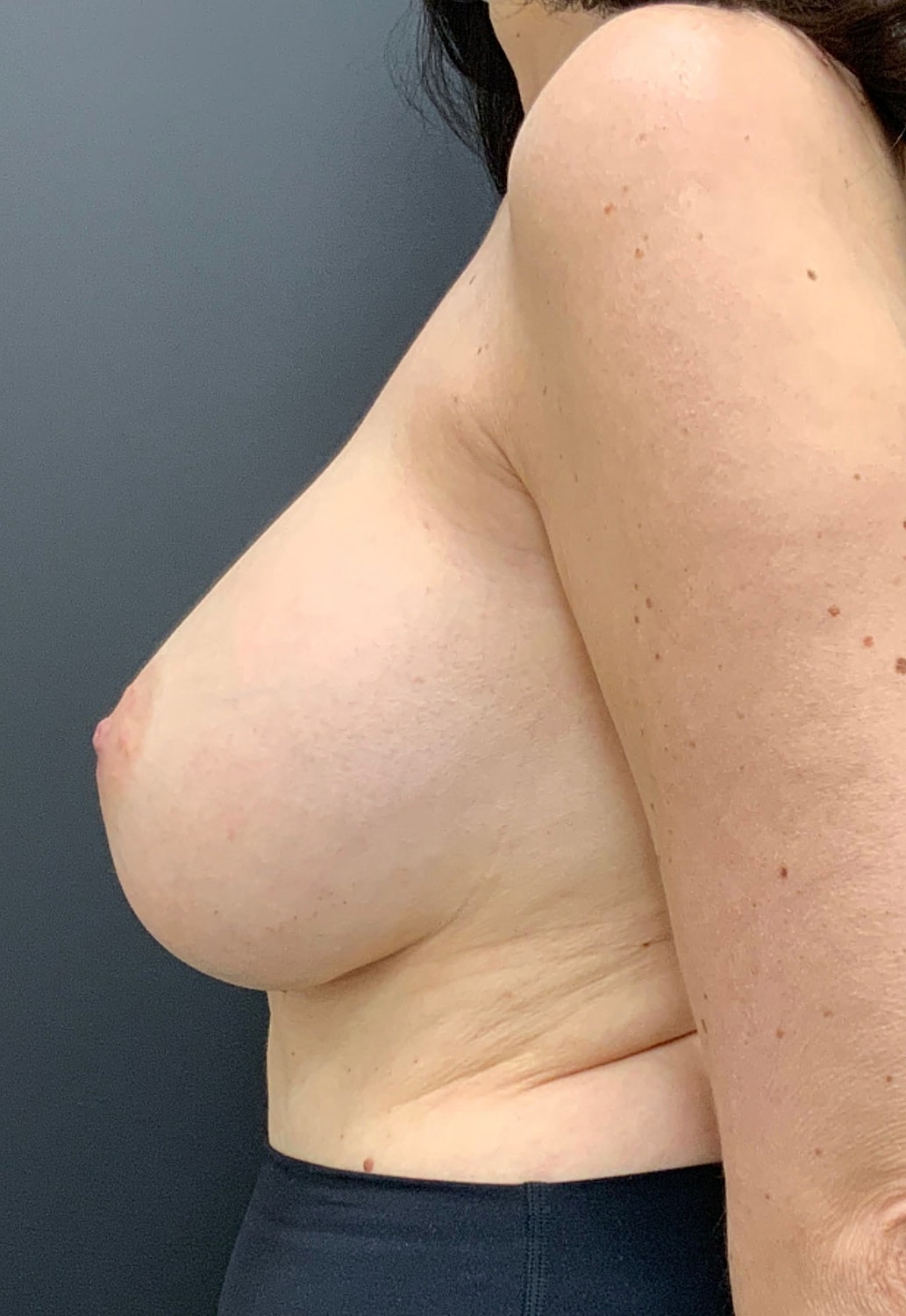 Breast Revision Before & After