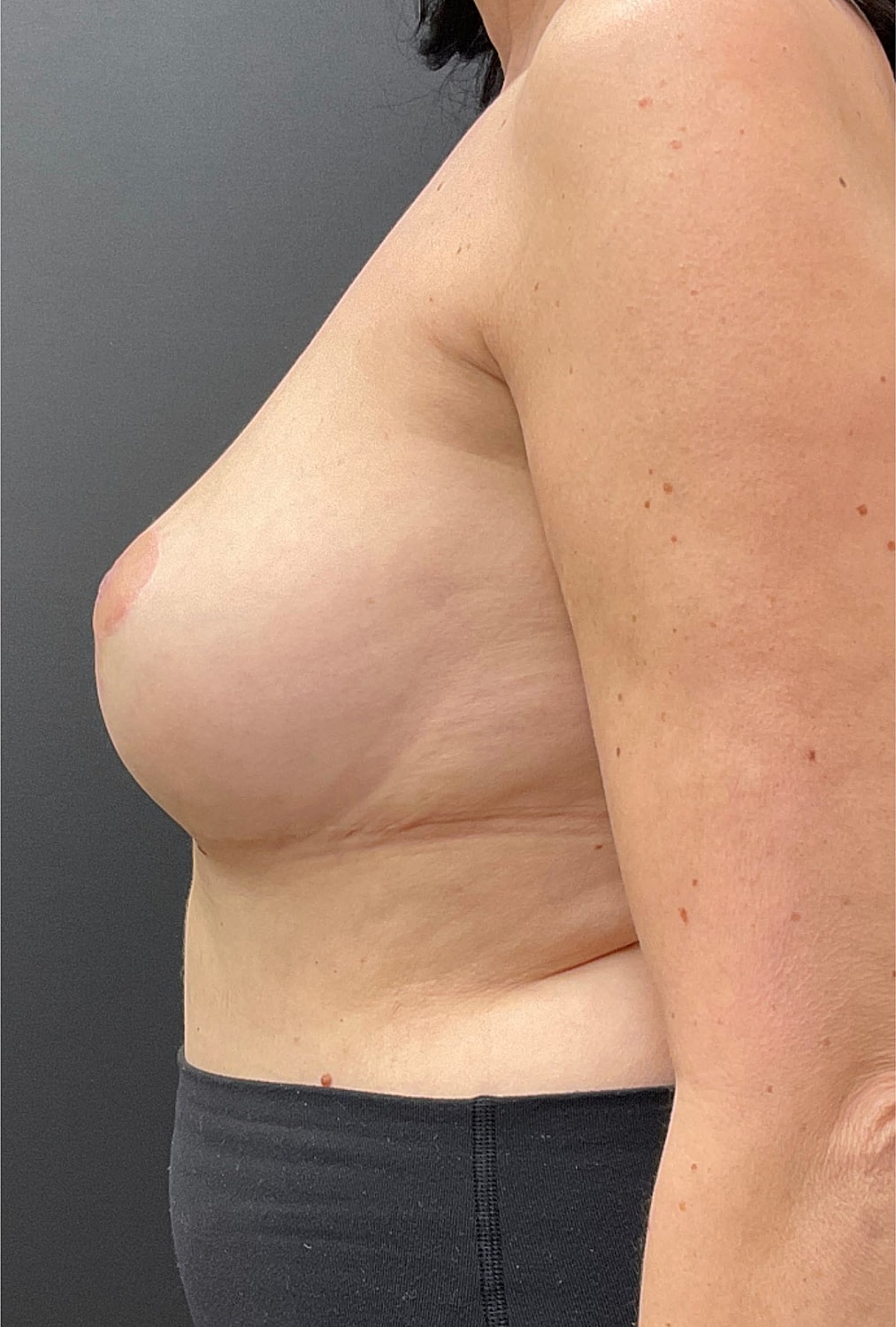 Breast Revision Before & After