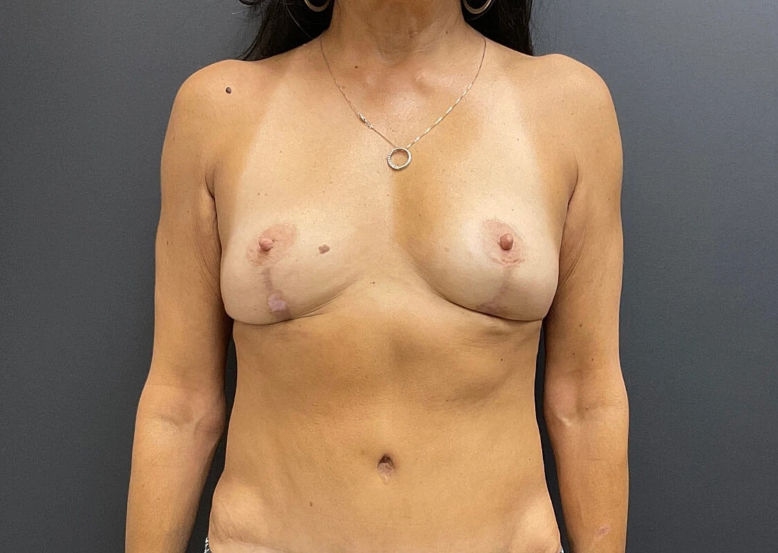 Breast Revision Before & After