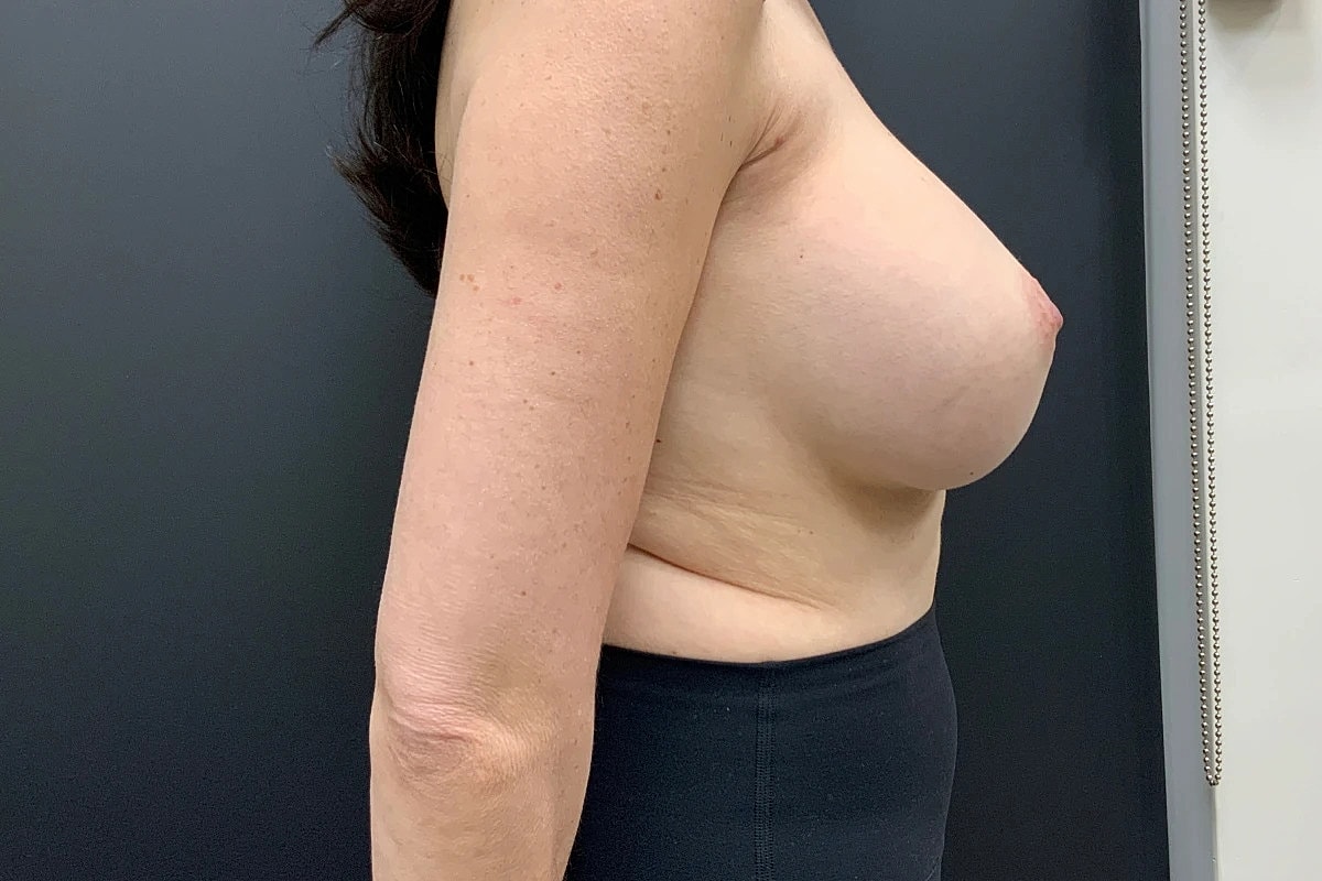 Breast Revision Before & After