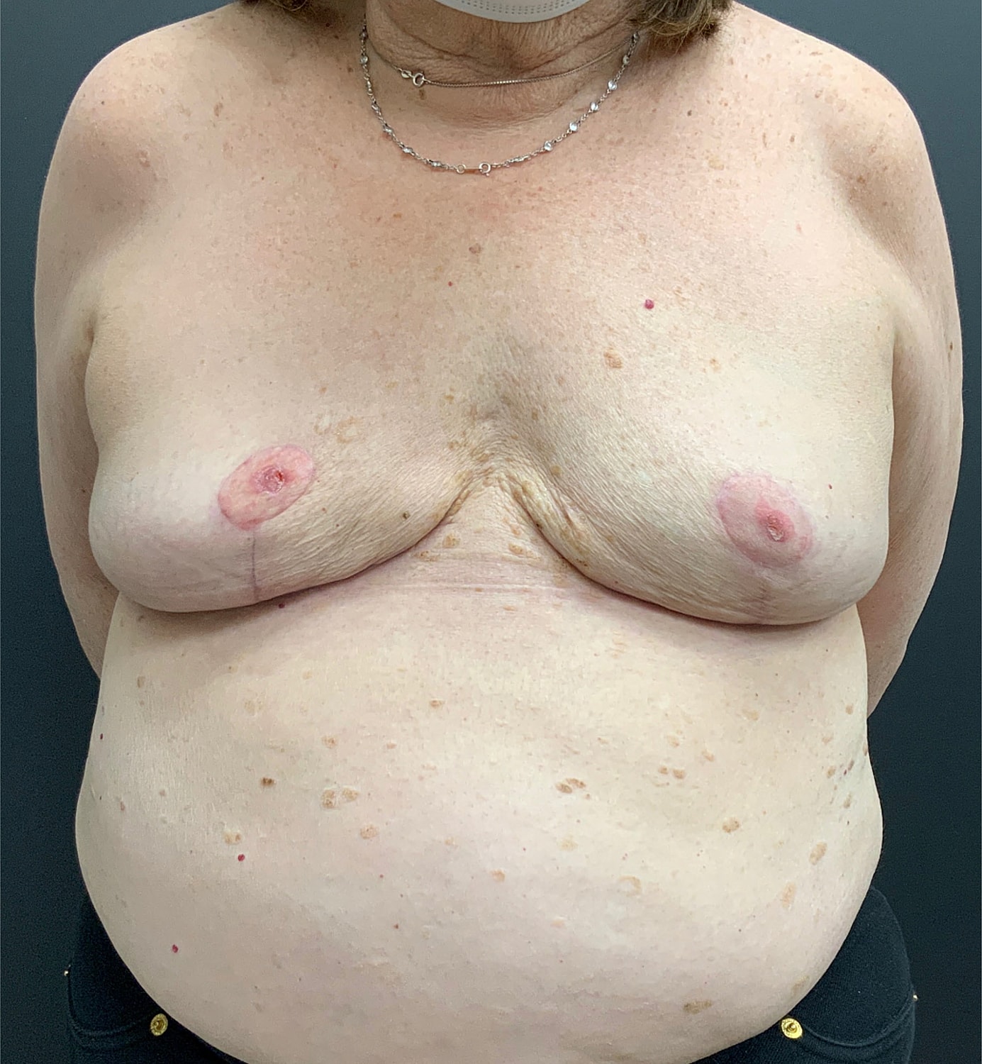 Breast Reconstruction Before & After