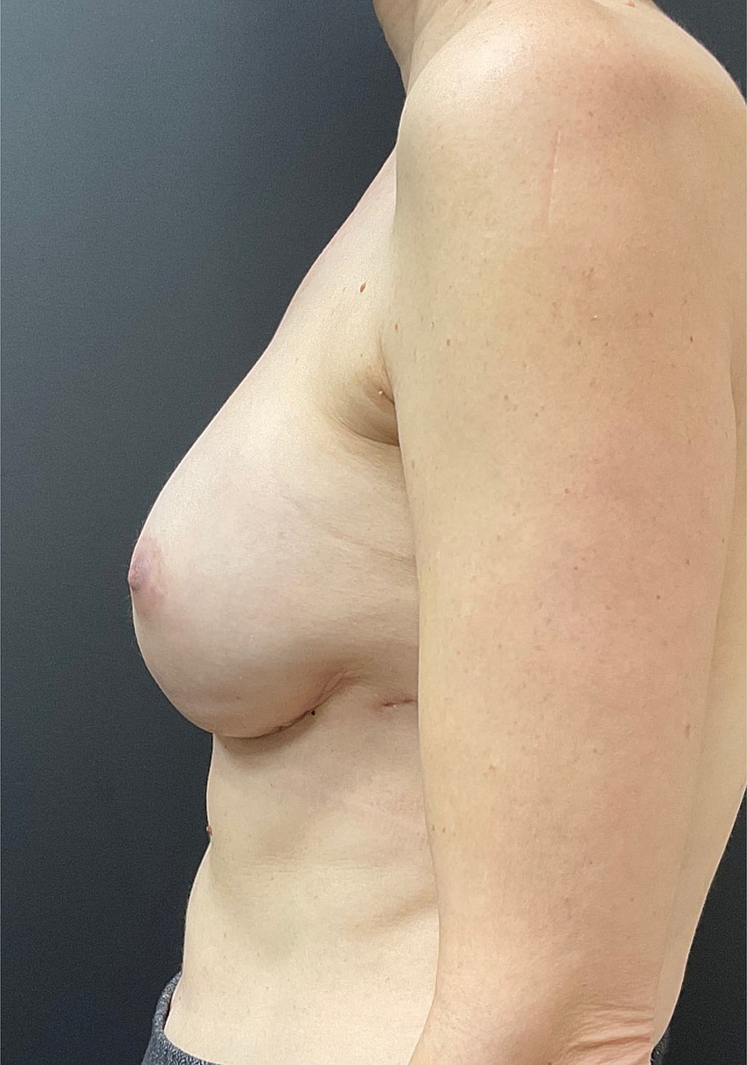 Breast Reconstruction Before & After