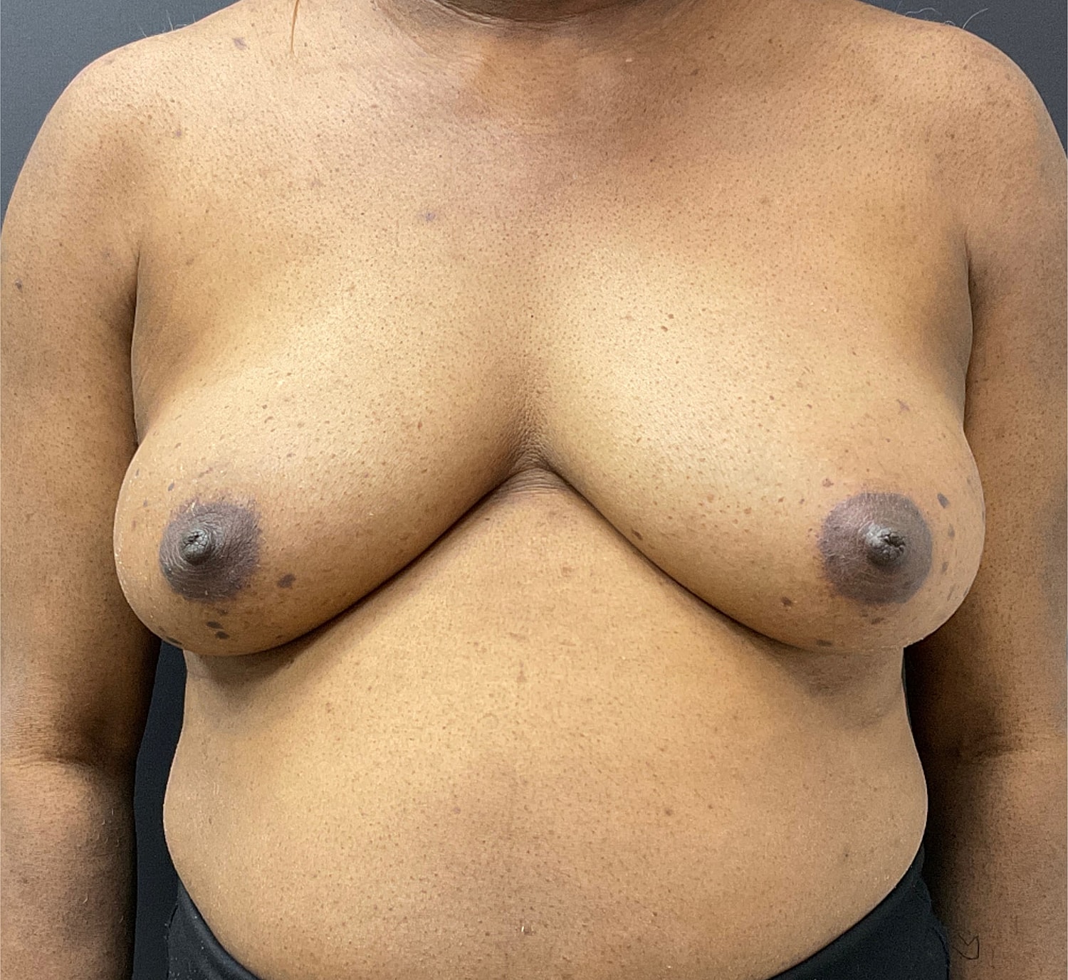 Breast Reconstruction Before & After