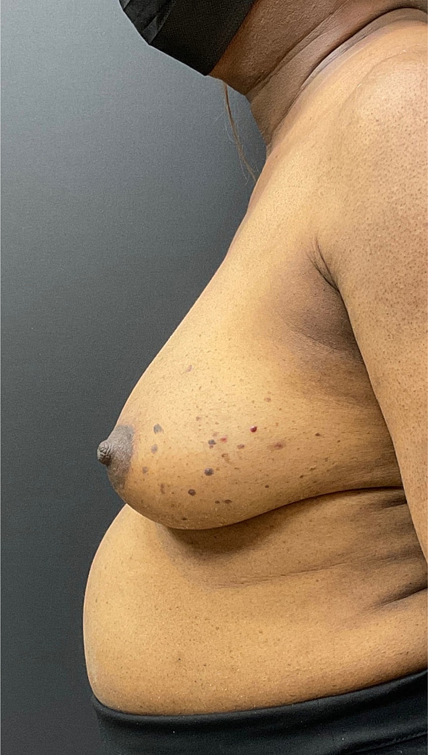 Breast Reconstruction Before & After