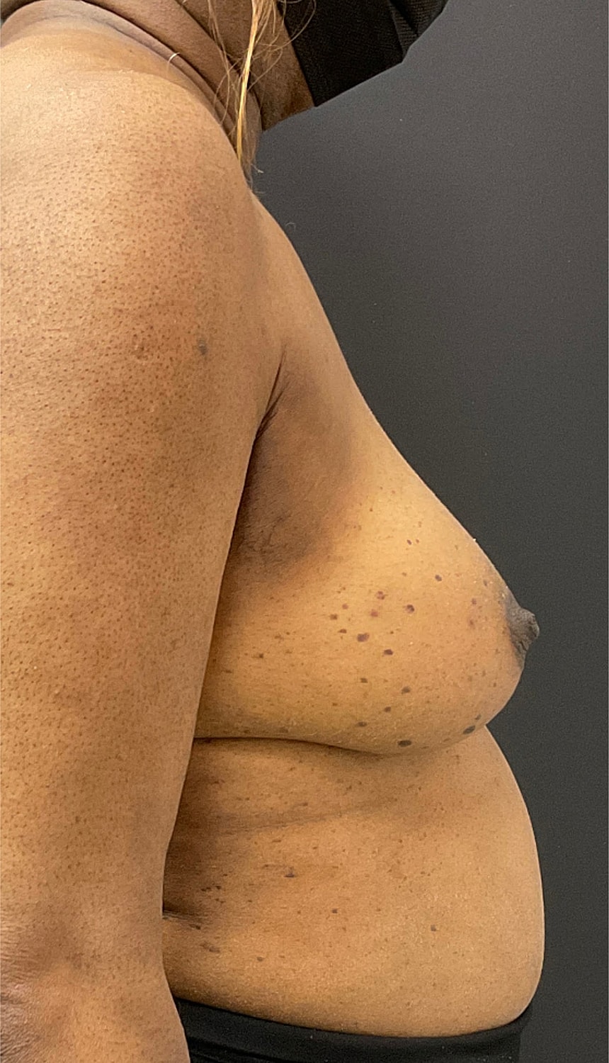 Breast Reconstruction Before & After