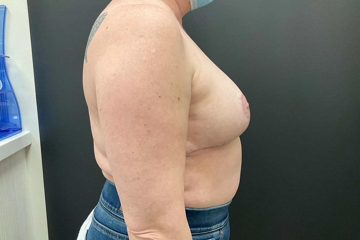 Breast Lift Before & After