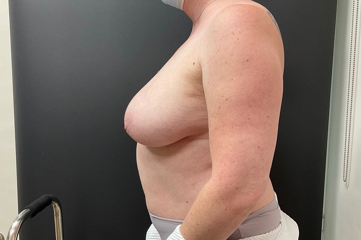 Breast Lift Before & After