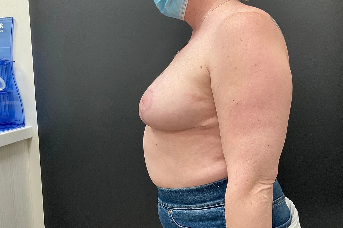 Breast Lift Before & After