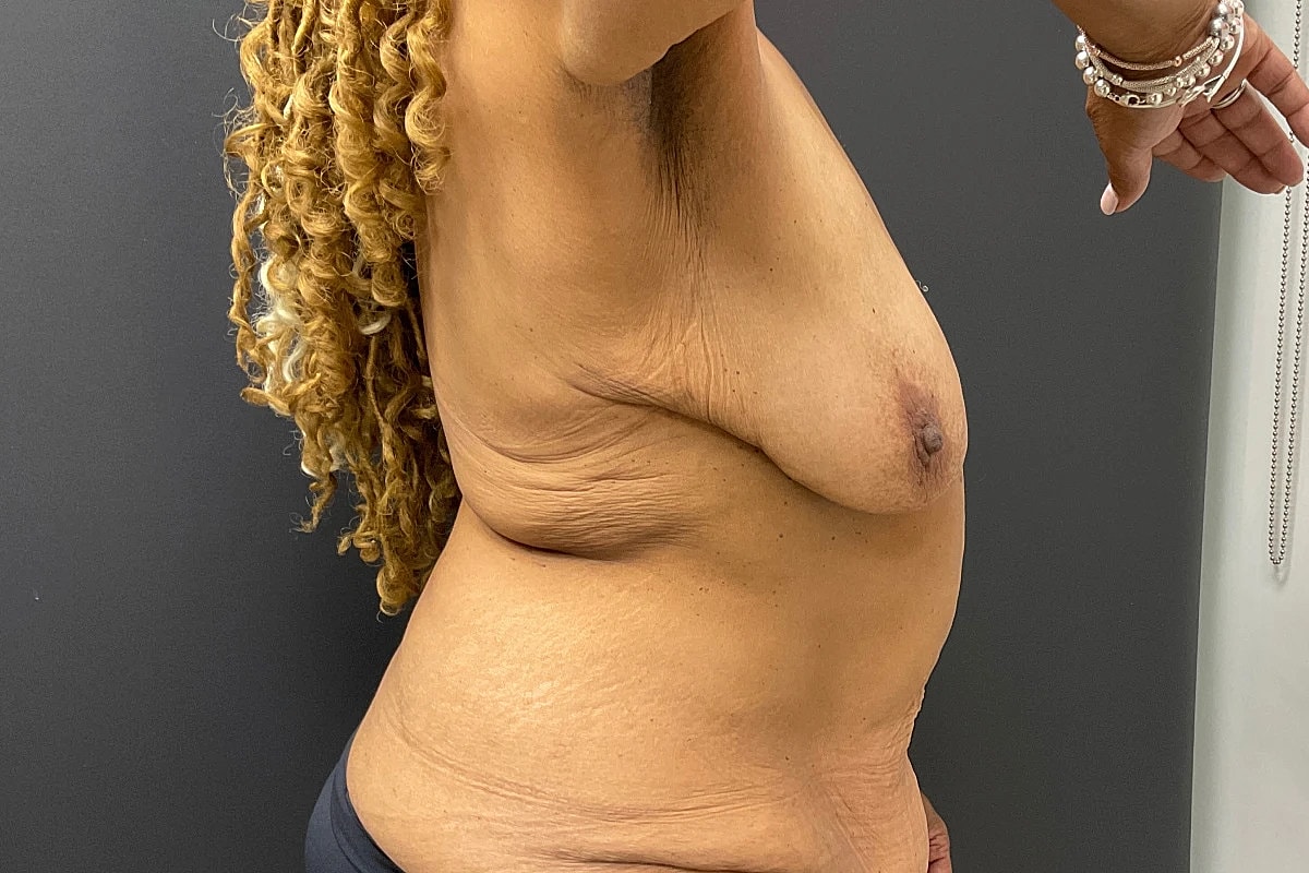 Breast Lift Before & After