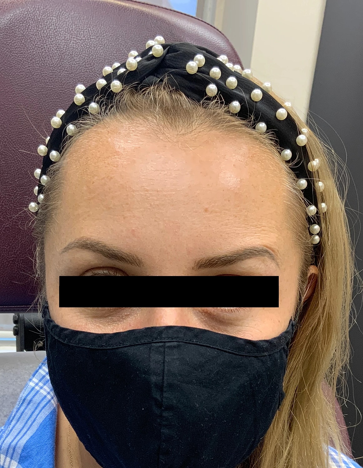 Neuromodulators Before & After
