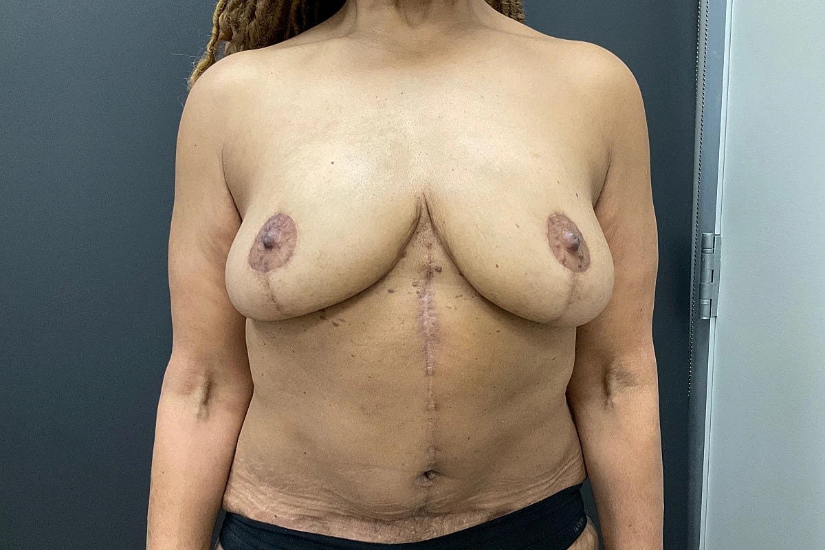 Mastopexy Before & After