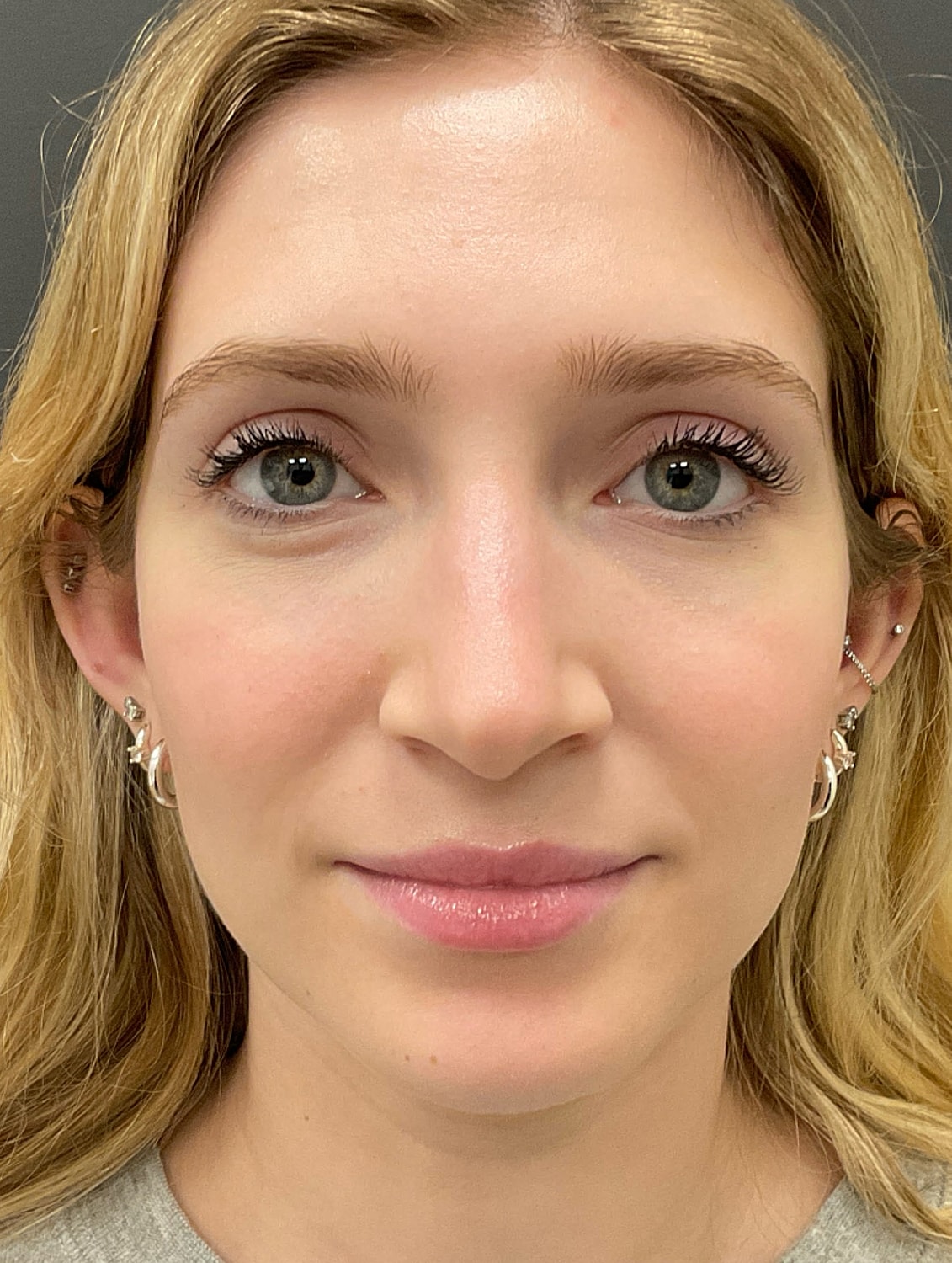Rhinoplasty Before & After