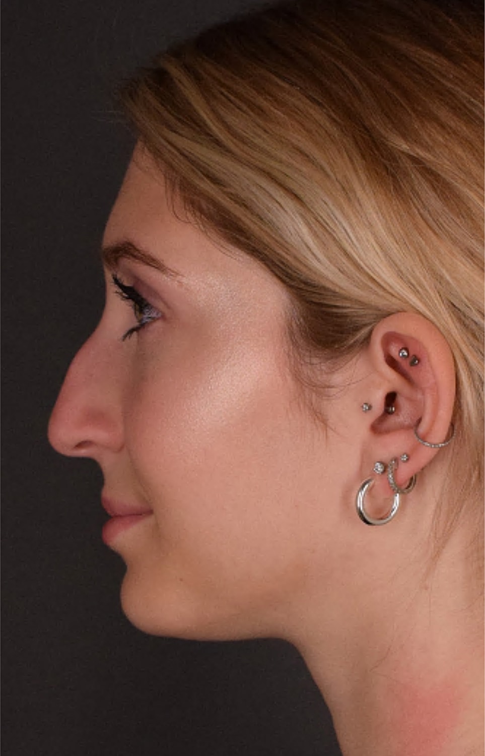 Rhinoplasty Before & After