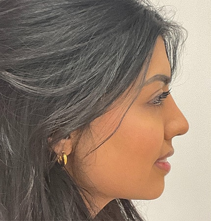 Rhinoplasty Before & After