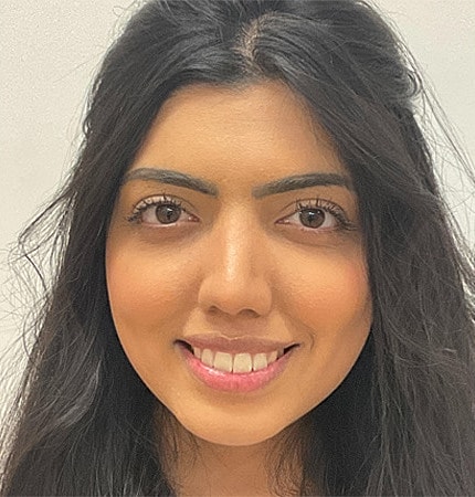 Rhinoplasty Before & After