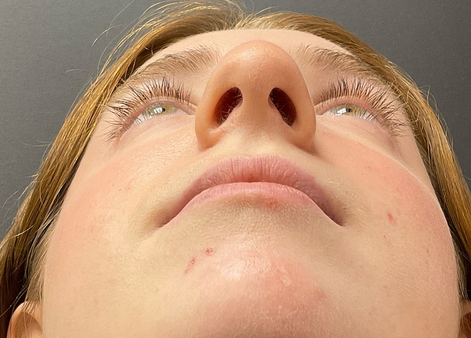 Rhinoplasty Before & After