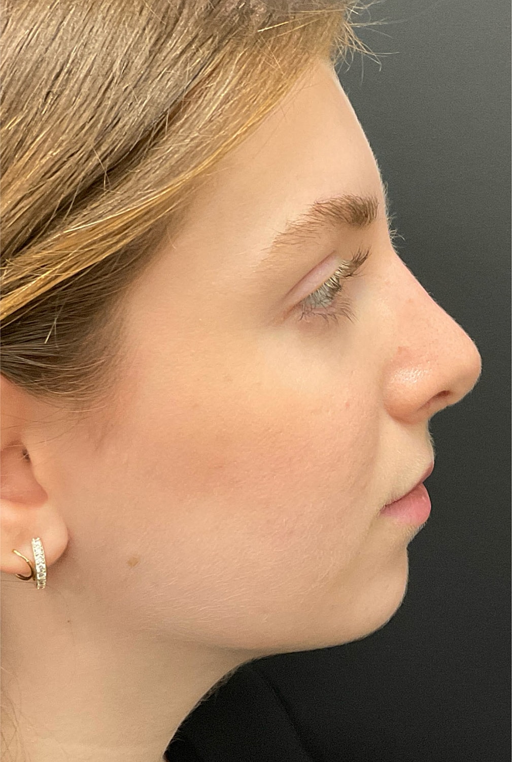 Rhinoplasty Before & After