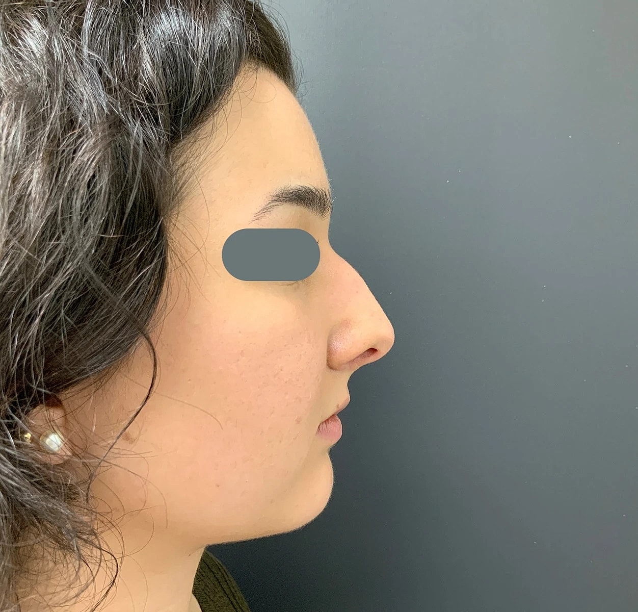 Rhinoplasty Before & After