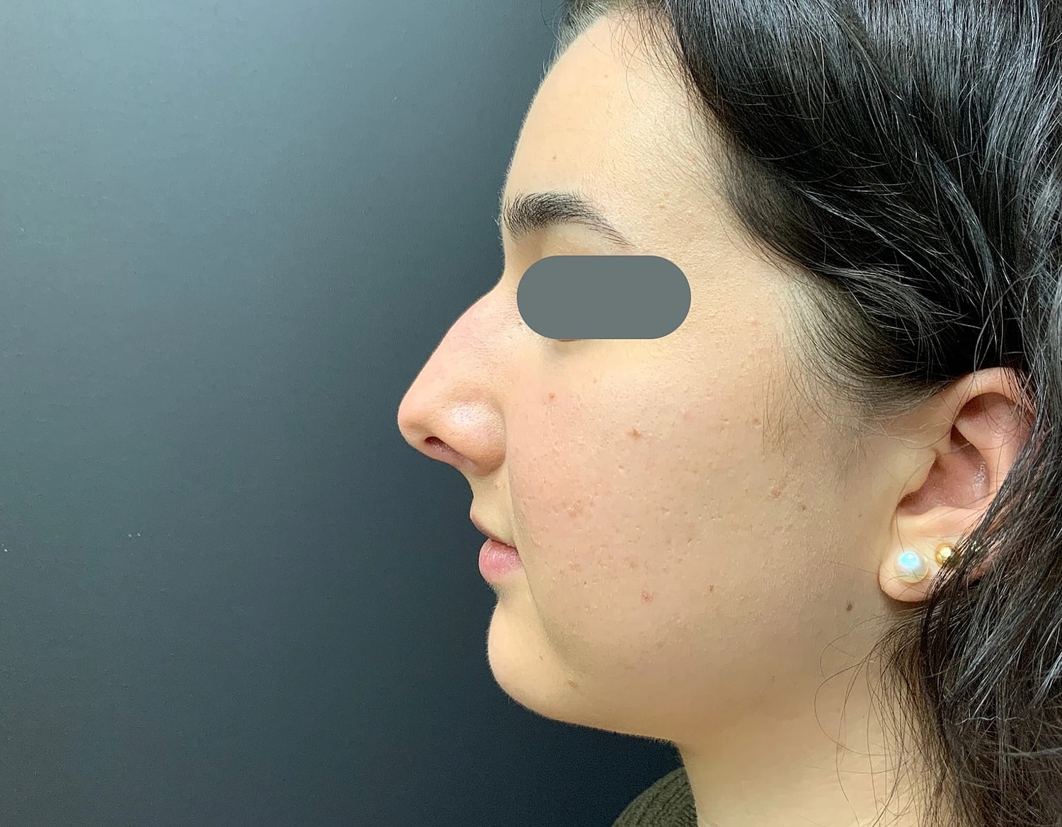Rhinoplasty Before & After