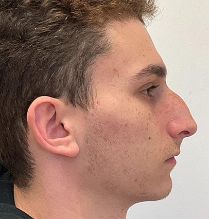 Rhinoplasty Before & After