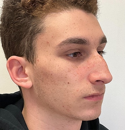 Rhinoplasty Before & After