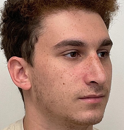 Rhinoplasty Before & After