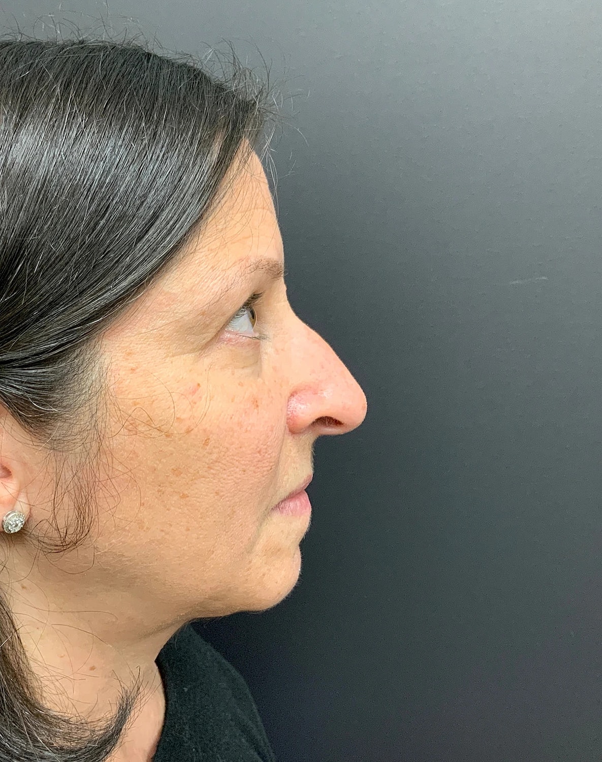 Rhinoplasty Before & After