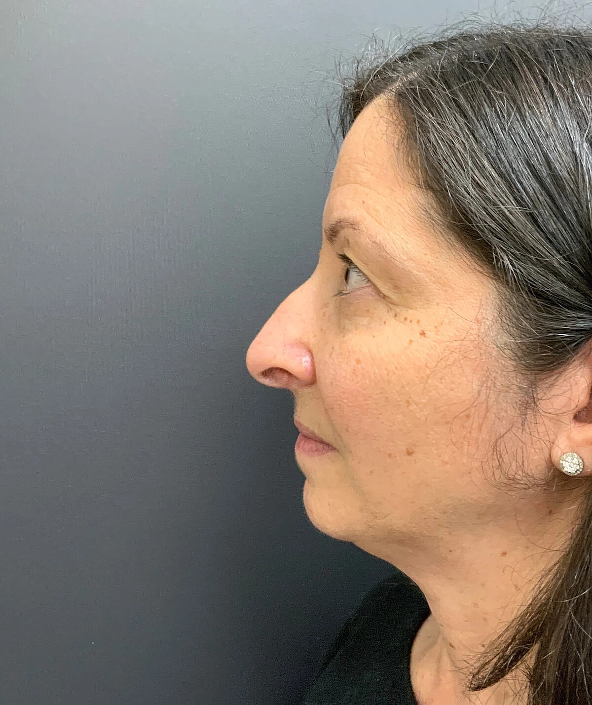 Rhinoplasty Before & After
