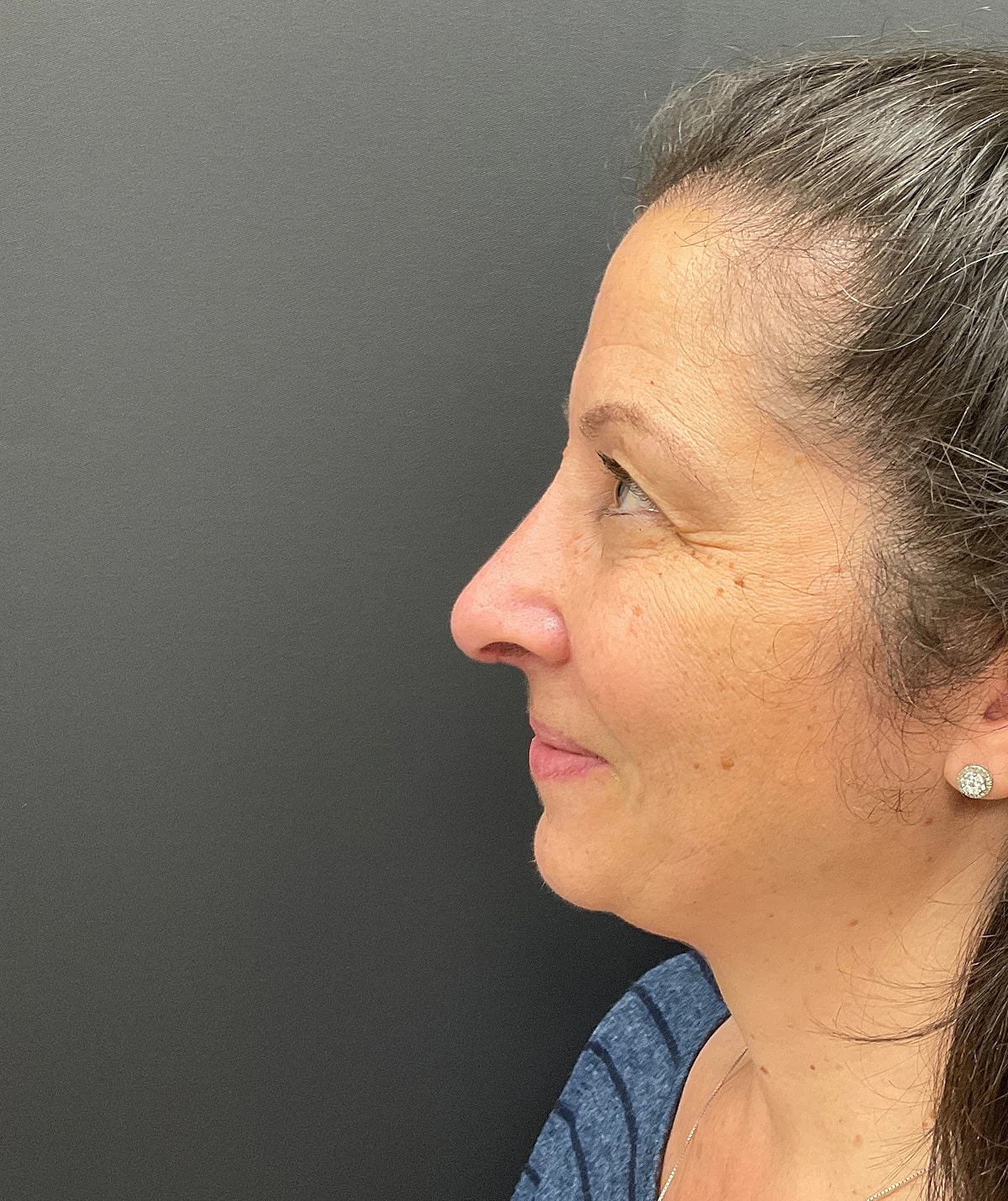 Rhinoplasty Before & After