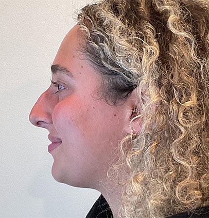 Rhinoplasty Before & After
