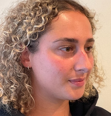 Rhinoplasty Before & After
