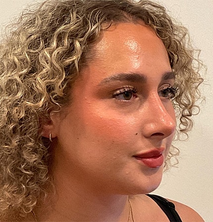 Rhinoplasty Before & After