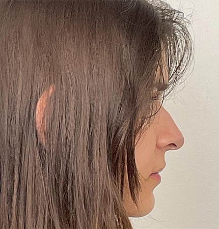 Rhinoplasty Before & After