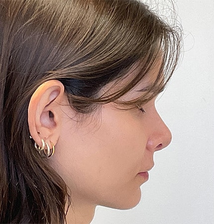 Rhinoplasty Before & After