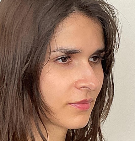 Rhinoplasty Before & After