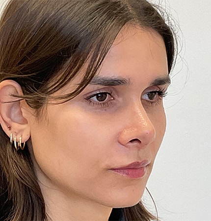 Rhinoplasty Before & After