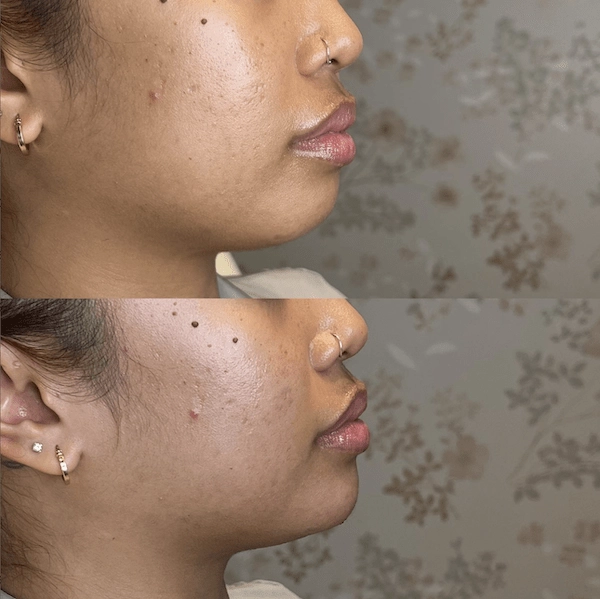 FORM Toronto Chin Filler Before After 1 Syringe resized
