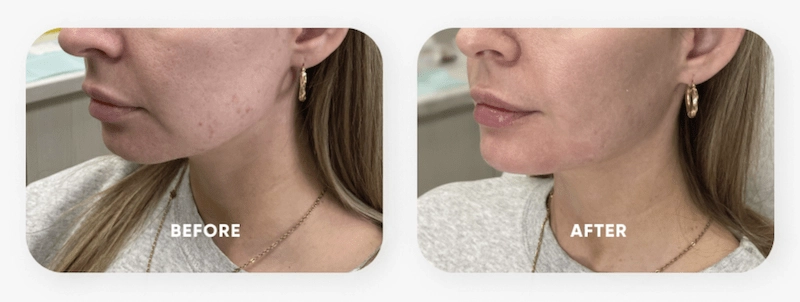 FORM-Toronto-Chin-Jawline-Filler-1.5-Syringes
