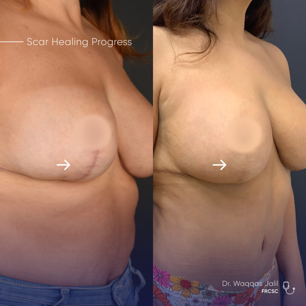 FORM Toronto Breast Reduction Breast Lift Scars Before After