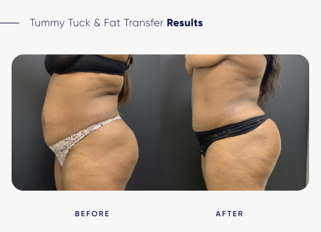 FORM-Toronto-Fat-Transfer-Hip-Dips-Tummy Tuck-Before-After-1.3