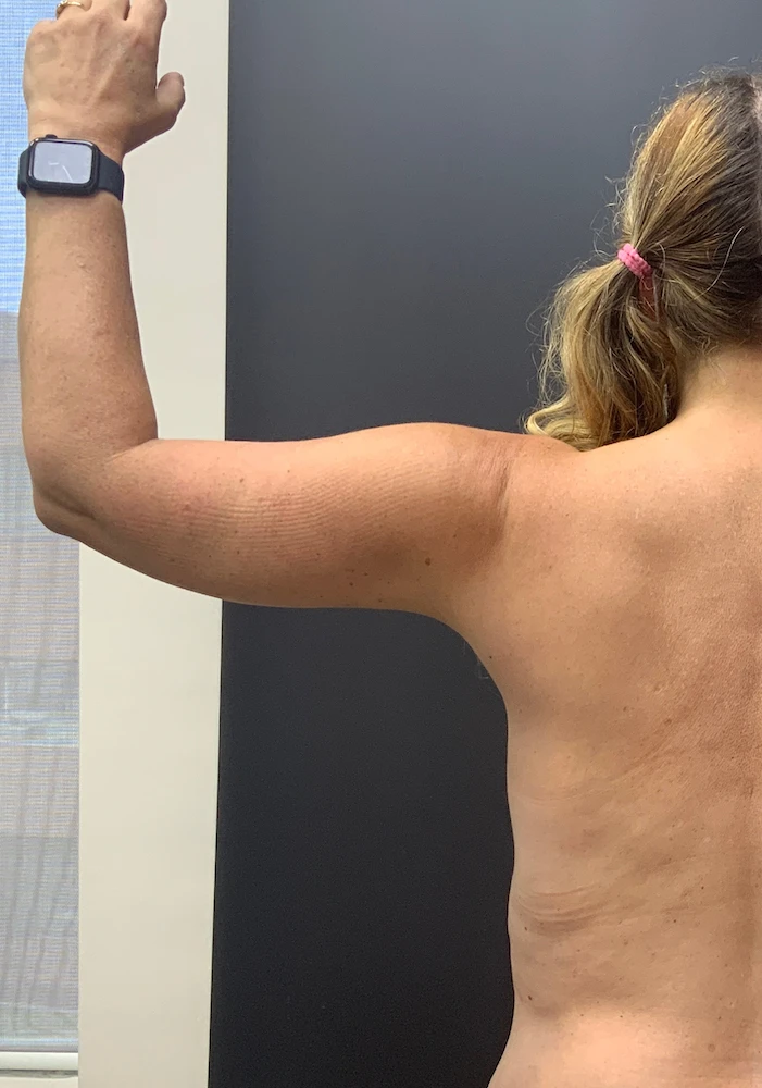 FORM-Toronto-Arm-Lift-Brachioplasty-Before-After