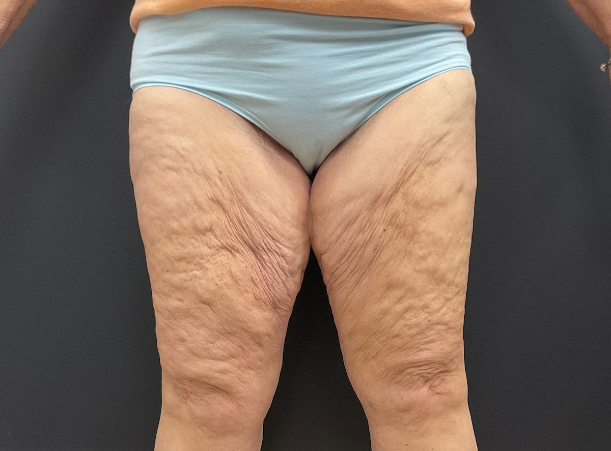 This patient's treatment plan included a thigh lift, extended arm lift, and Fleur-de-Lis abdominoplasty to remove and tighten the extensive loose skin she was left with after significant weight loss. These vertical thigh lift results are shown at three months post